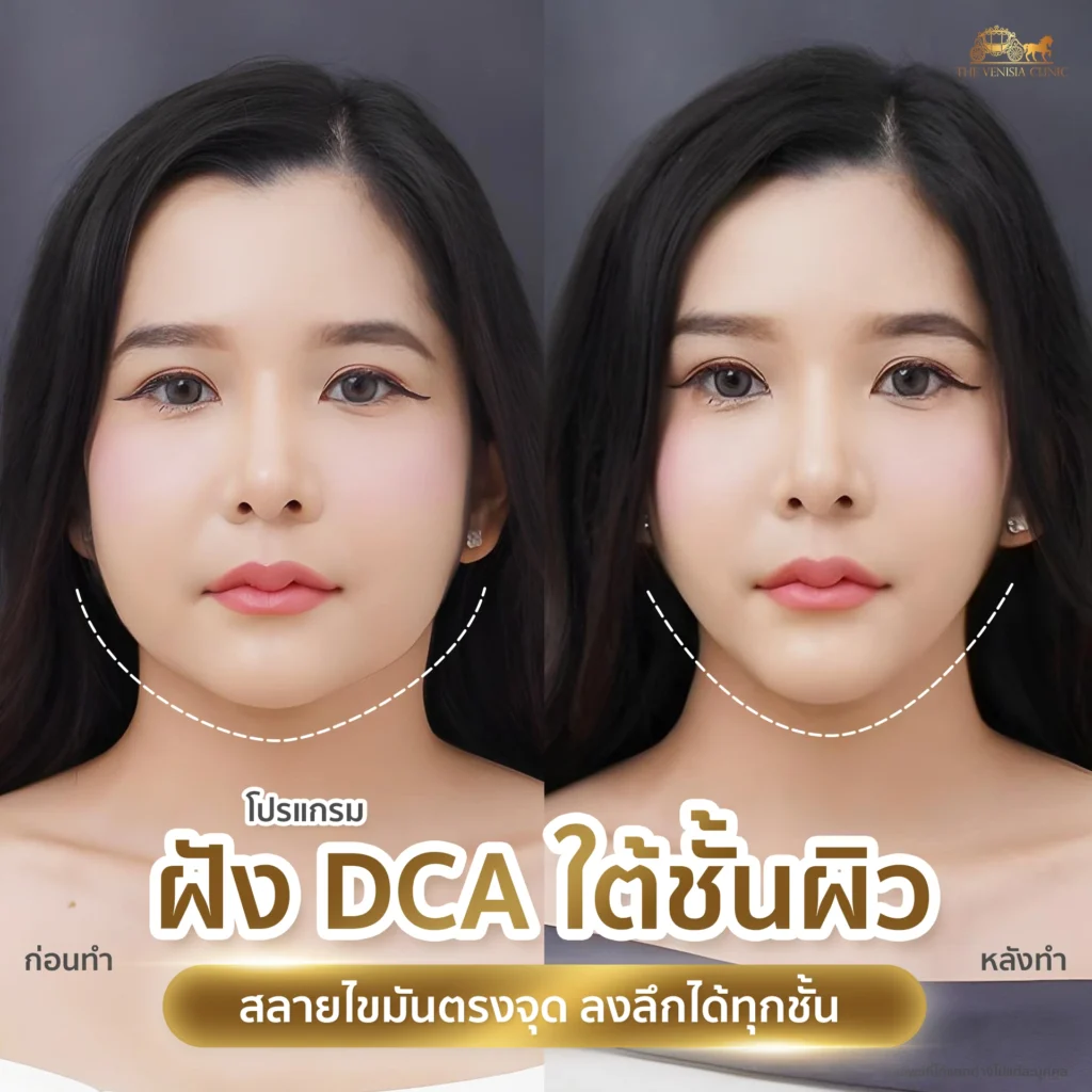 หน้าเรียว ผิวแน่นกระชับขึ้นแบบไม่ต้องผ่าตัด