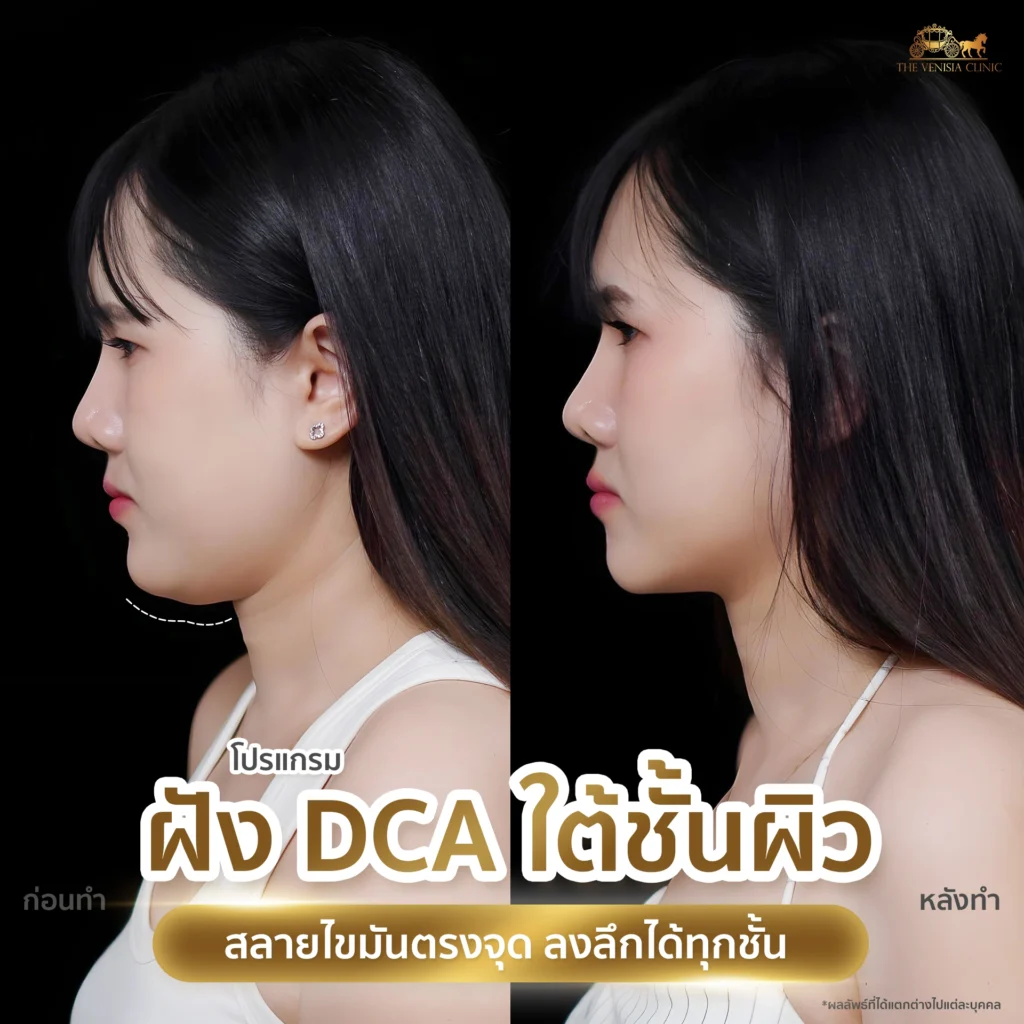 รีวิว DCA มุมข้างหน้าเรียว ลดไขมันแก้มอย่างเห็นได้ชัด