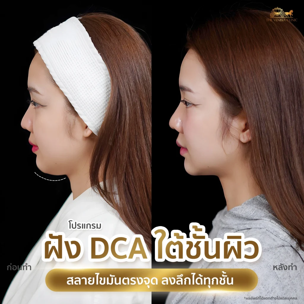 รีวิว DCA หน้าเรียว V-Shape ปรับรูปหน้าโดยไม่ต้องศัลยกรรม