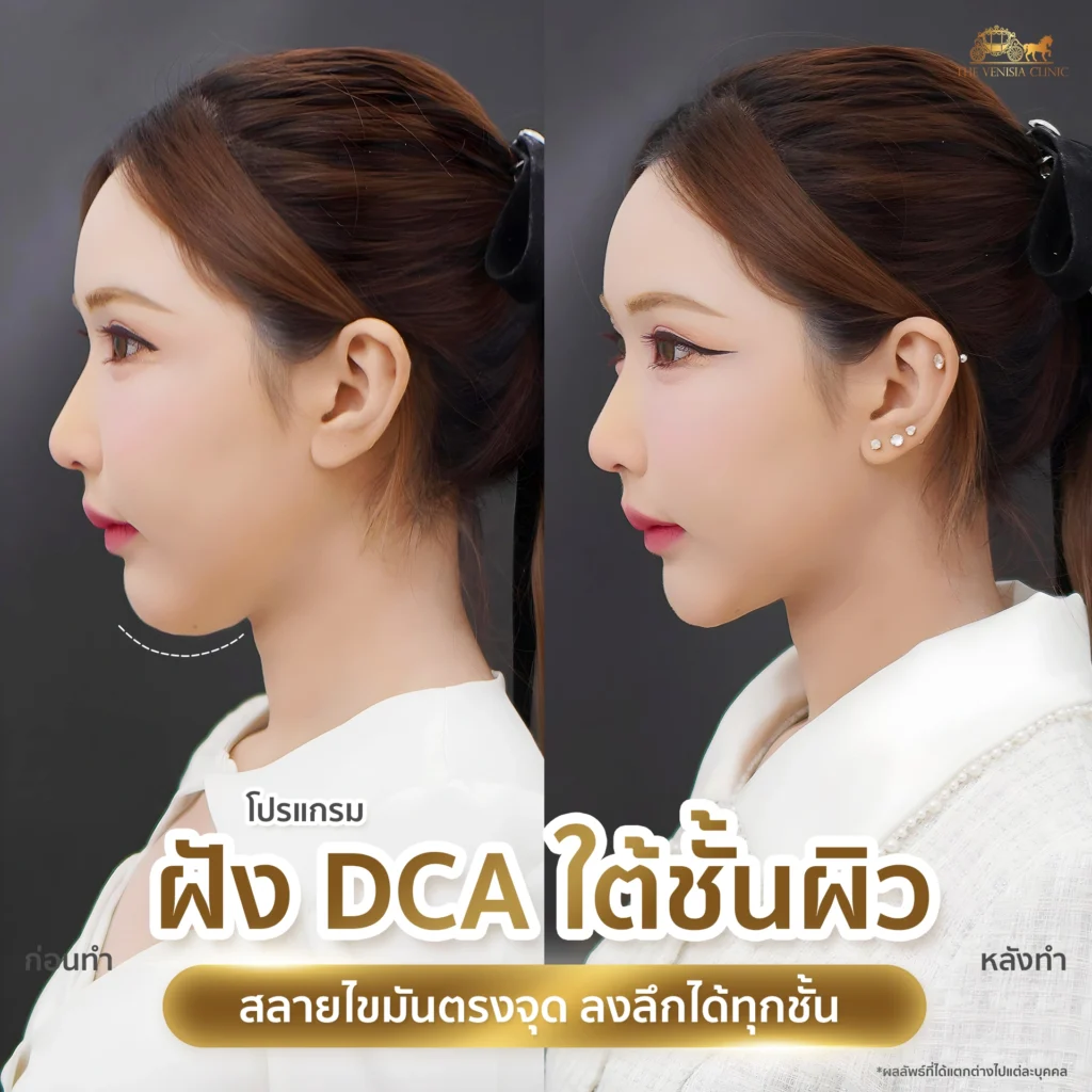 ยกกระชับหน้าเรียวจากมุมข้างแบบเห็นชัดเจน