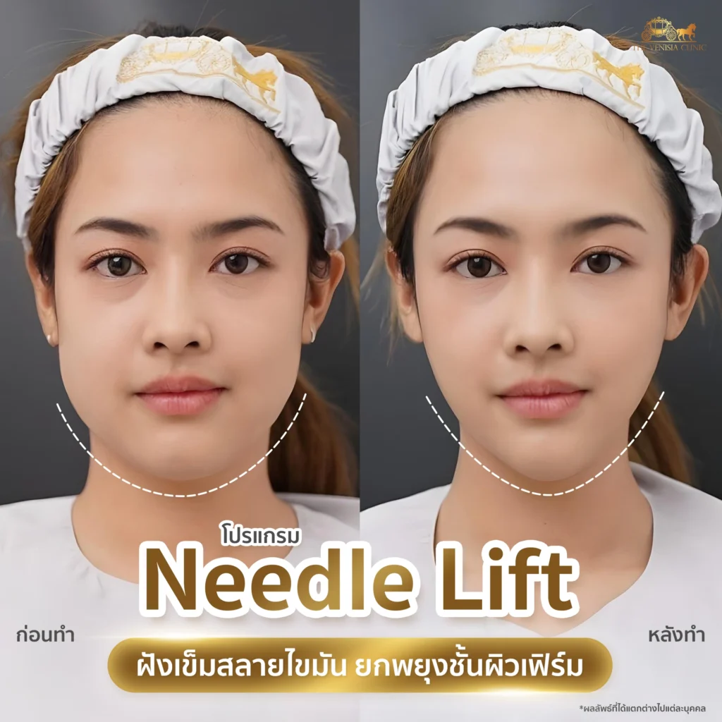 เคส ยกกระชับหน้า โครงหน้าคมชัดขึ้นด้วยเทคนิคเลเซอร์เข็ม