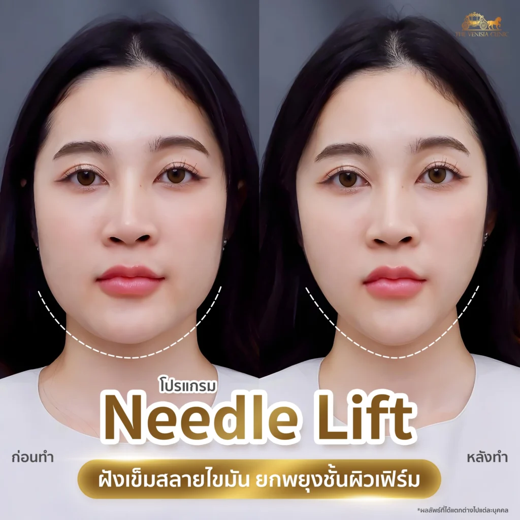 รีวิว Needle Lift เคสผิวหย่อน หน้าแน่นขึ้นเห็นชัด