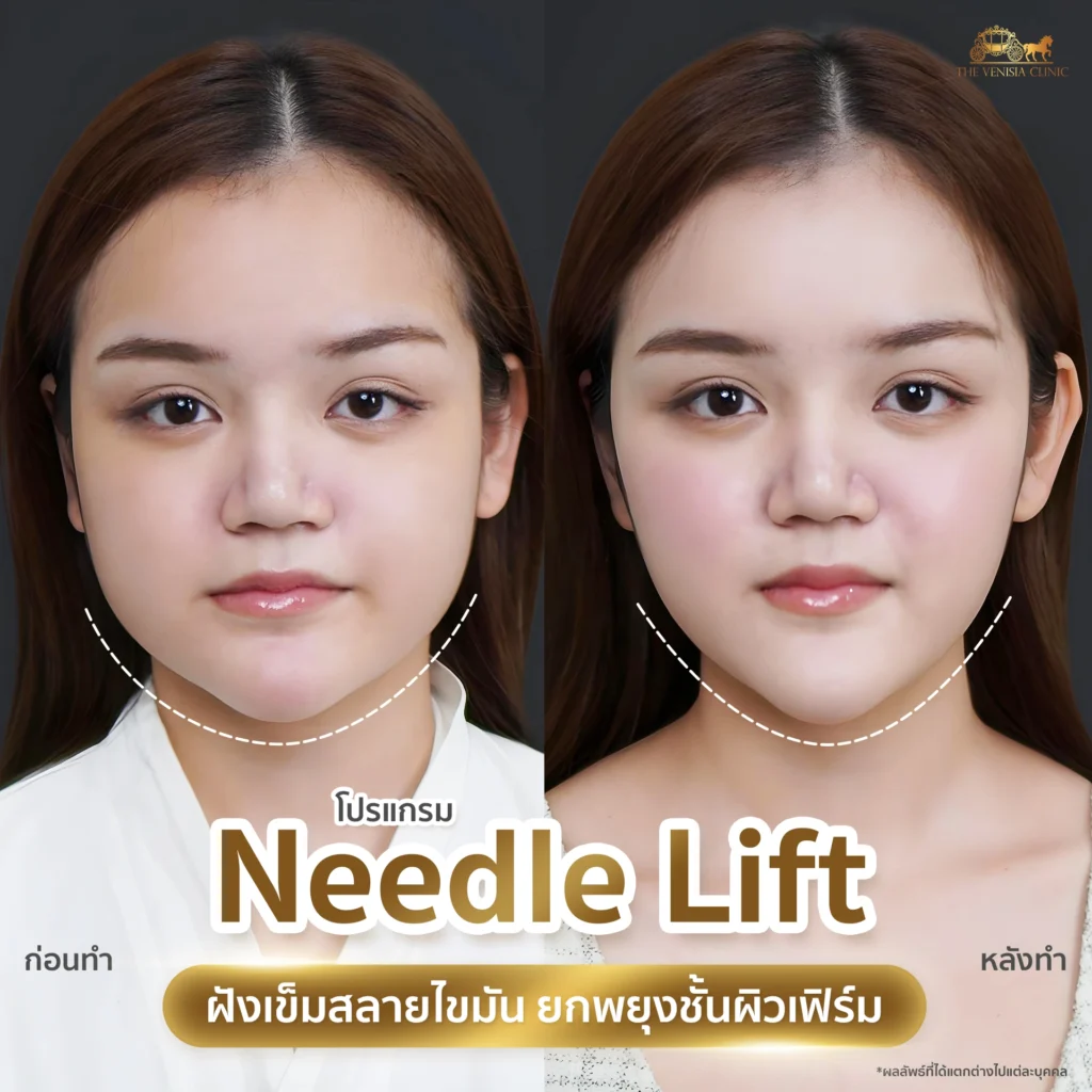 ยกกระชับหน้า ด้วย Needle Lift ลดความหย่อนคล้อยแบบไม่ต้องพักฟื้น