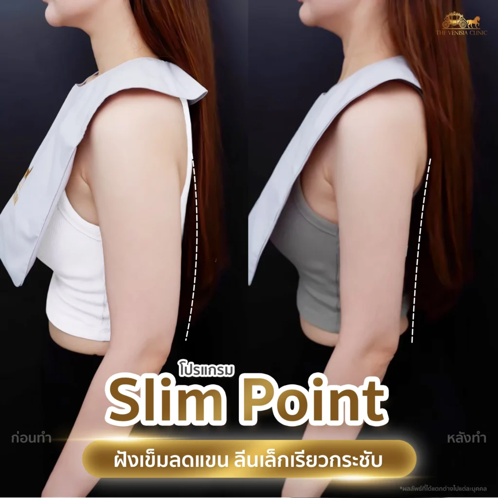 ลดต้นแขน ด้วย Slim Point แขนเรียวขึ้นโดยไม่ต้องผ่าตัด