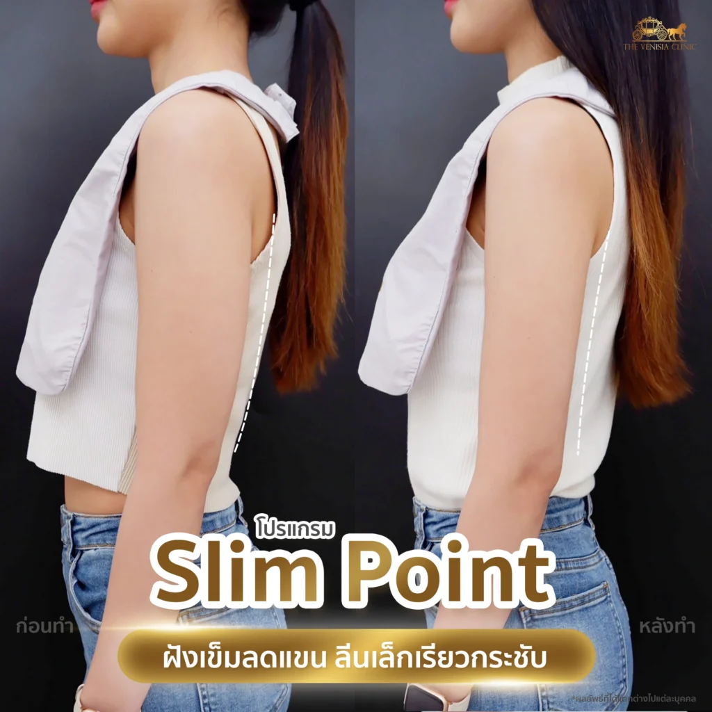 รีวิวแขนเรียวขึ้นอย่างเป็นธรรมชาติ ด้วย Slim Point