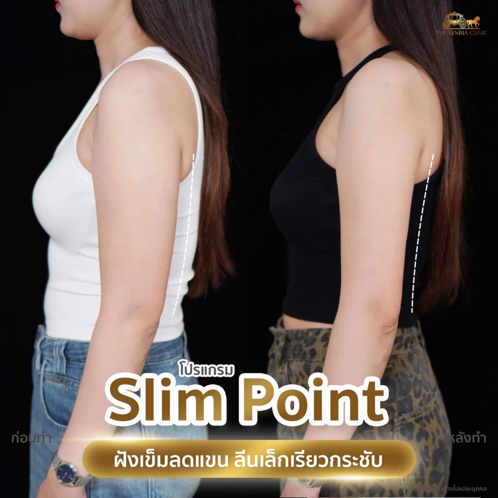 แขนเล็กลงชัดเจนหลังโปรแกรมลดไขมันเฉพาะจุด