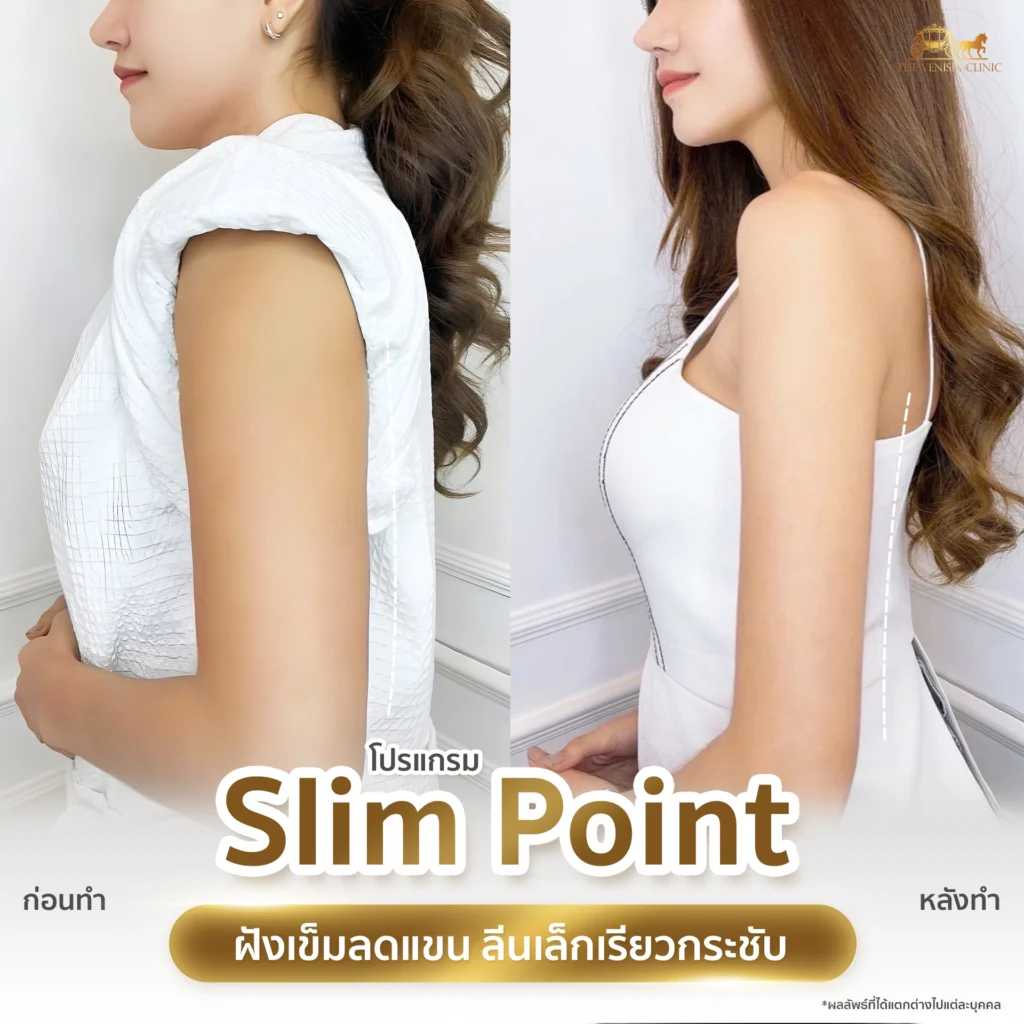 เคส ลดต้นแขน ด้วย Slim Point แบบไม่ต้องพักฟื้น