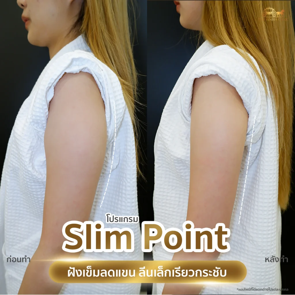 รีวิวเคสต้นแขนใหญ่ ปรับให้เล็กลงด้วย Slim Point