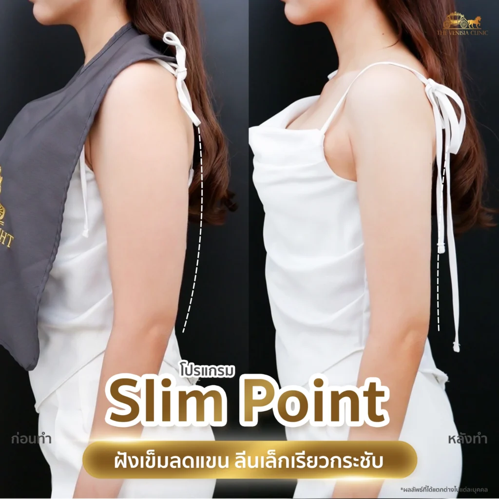 ผลลัพธ์ลดไขมันต้นแขน แขนดูเรียวยาวและกระชับ