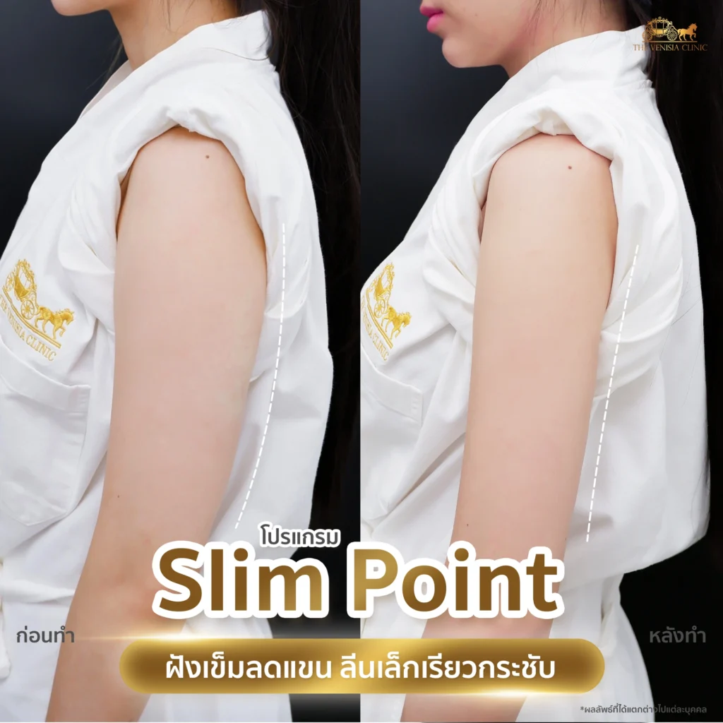 เปรียบเทียบต้นแขนก่อนและหลังโปรแกรม Slim Point