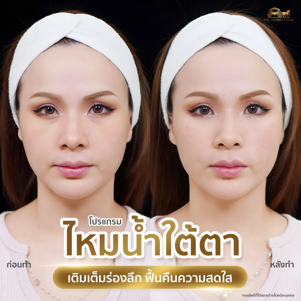 ใต้ตาหายคล้ำในผู้หญิงหน้าคมหลังฉีดไหมน้ำ