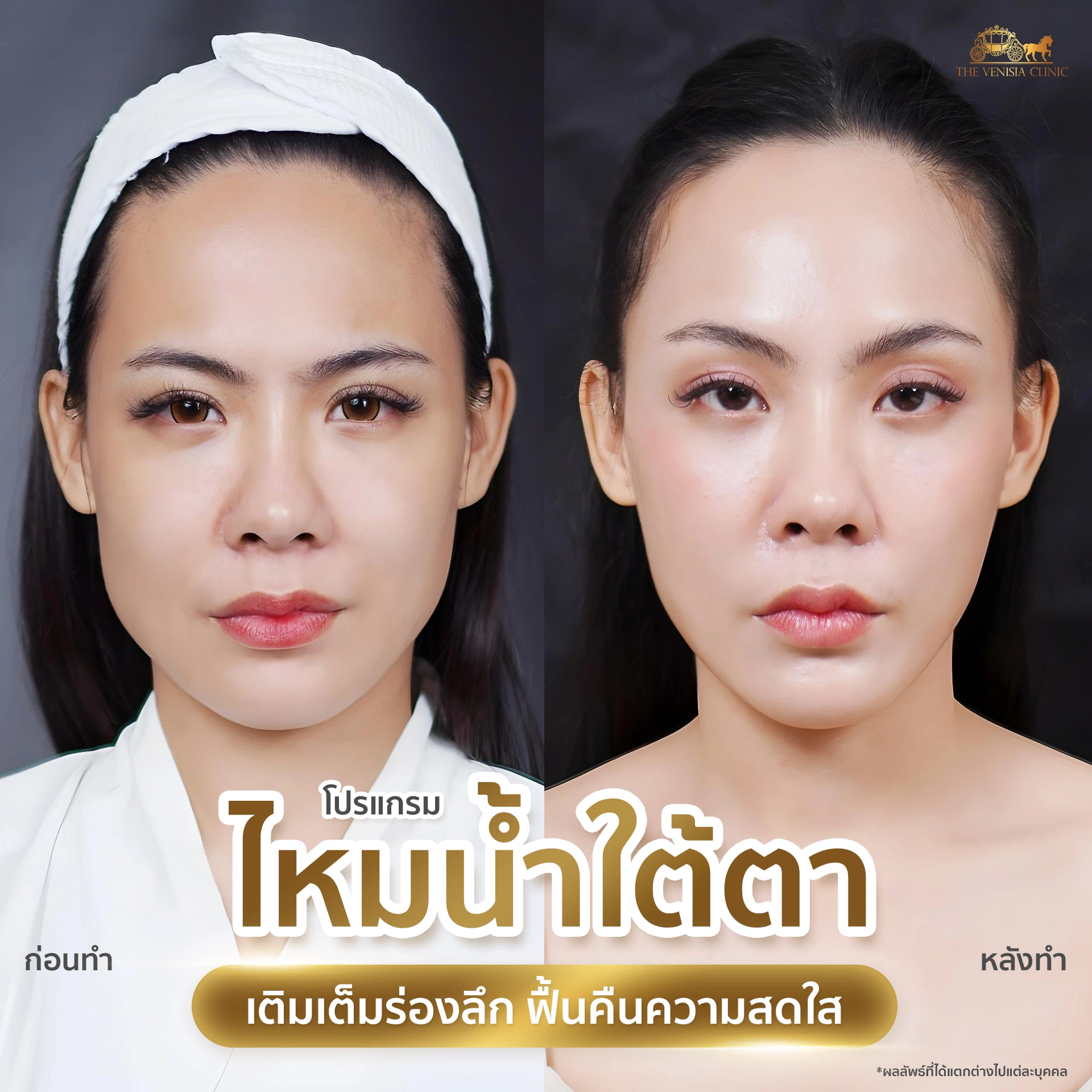 รีวิวฟื้นฟูใต้ตาและถุงใต้ตาด้วยไหมน้ำ Ultra Filler