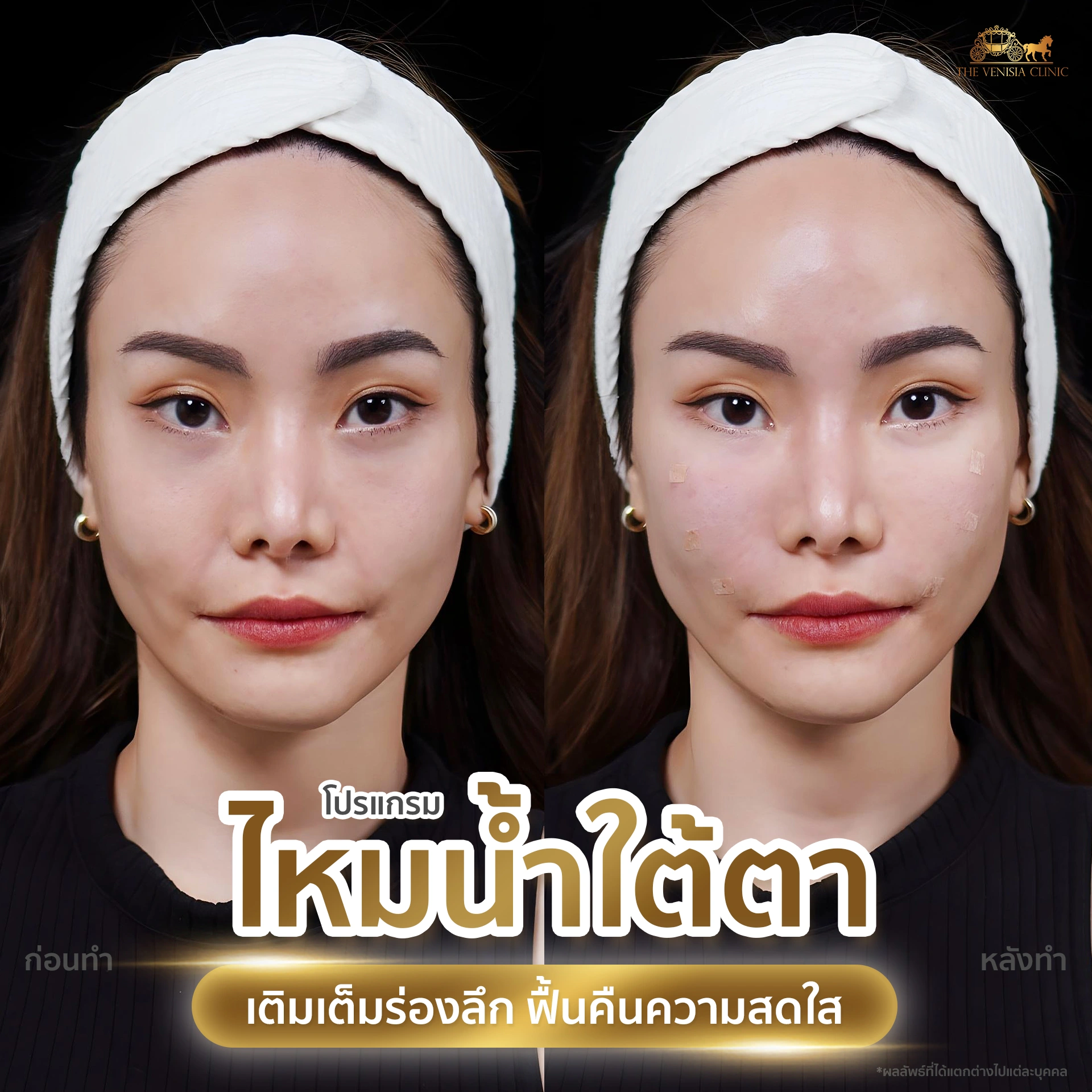 รีวิวคู่แฝดฉีดไหมน้ำใต้ตา โปรแกรมฟื้นฟูความสดใสใต้ตา