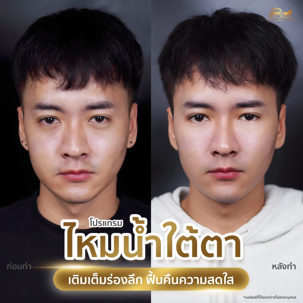 เคสผู้ชายฉีดไหมน้ำใต้ตา หน้าไบร์ทขึ้นหลังทำ Ultra Filler