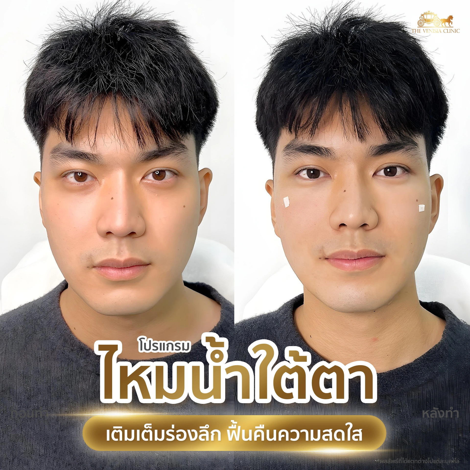 ผลลัพธ์การฟื้นฟูใต้ตาด้วยไหมน้ำในผู้ชาย