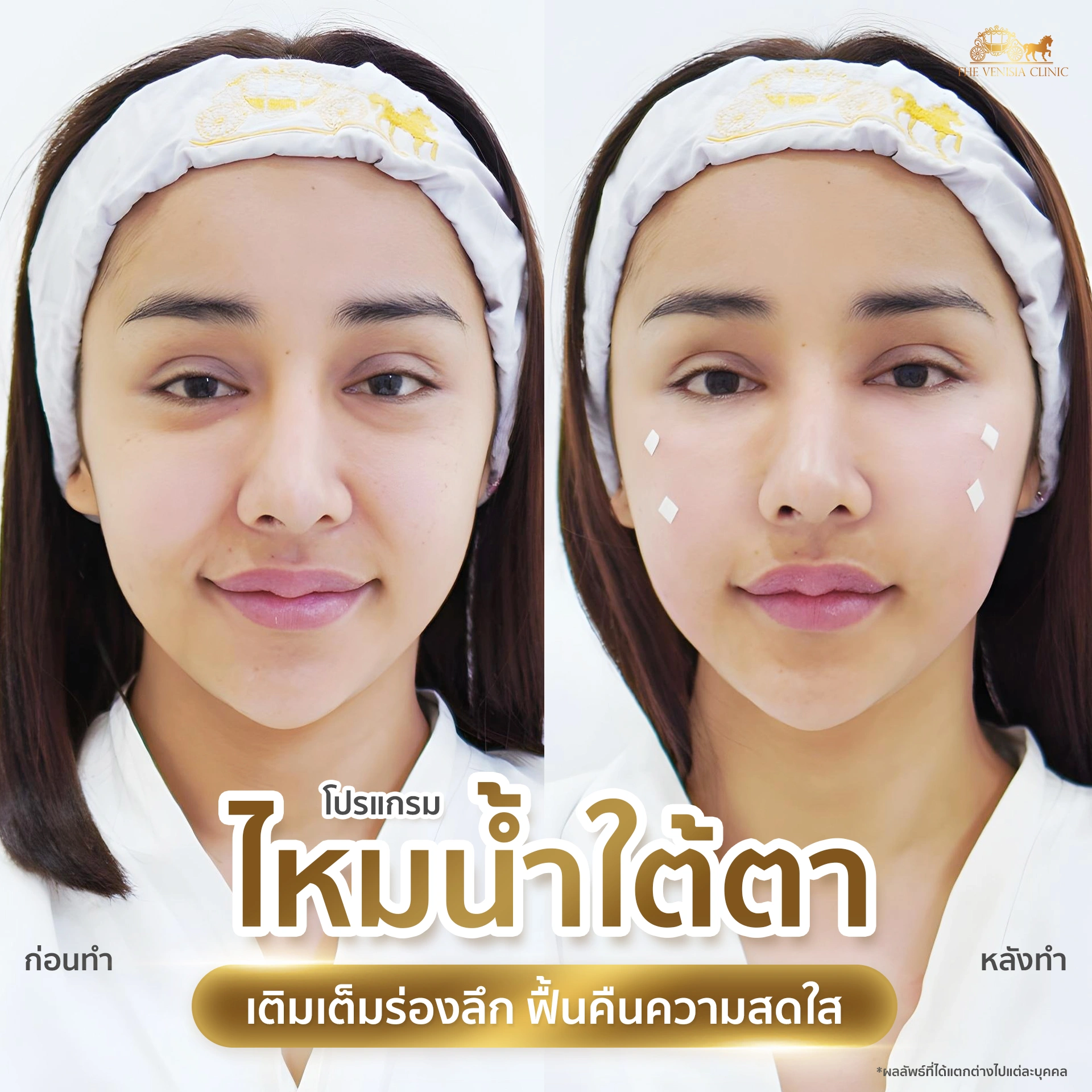 เปรียบเทียบก่อนหลังฉีดไหมน้ำใต้ตา โปรแกรม Ultra Filler ใต้ตาดูอิ่มฟู