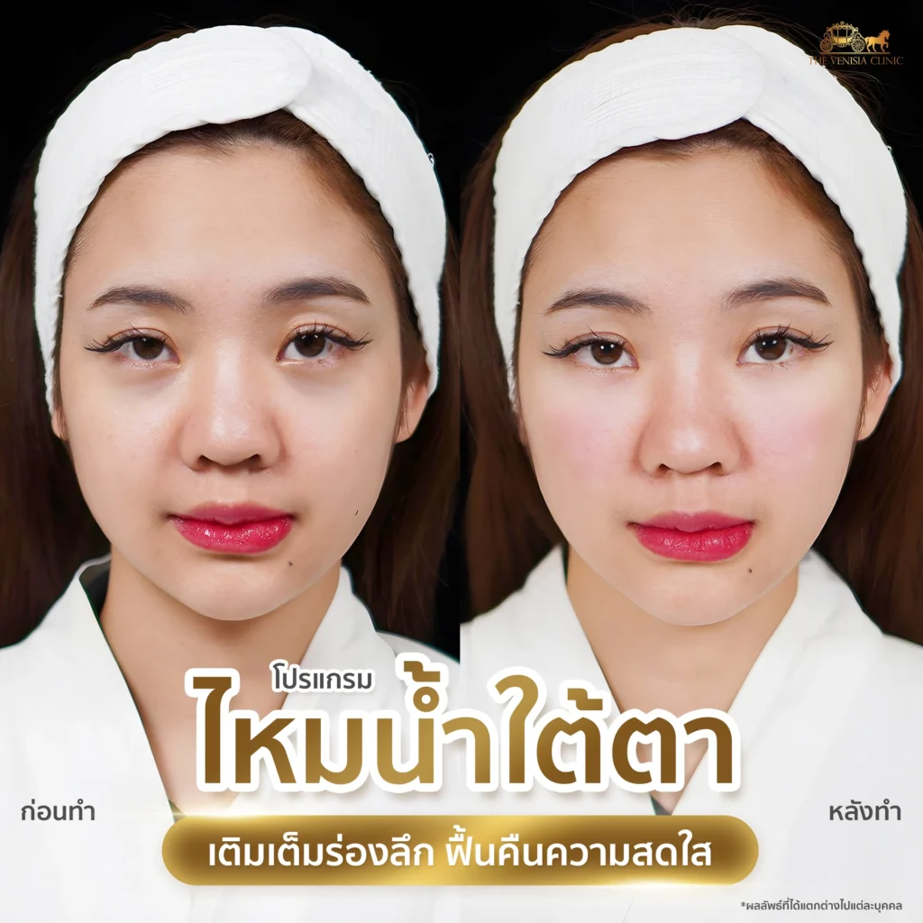 รีวิวผลลัพธ์ไหมน้ำใต้ตา ลดความหมองคล้ำ ใต้ตาดูสดใสขึ้นด้วย Ultra Filler
