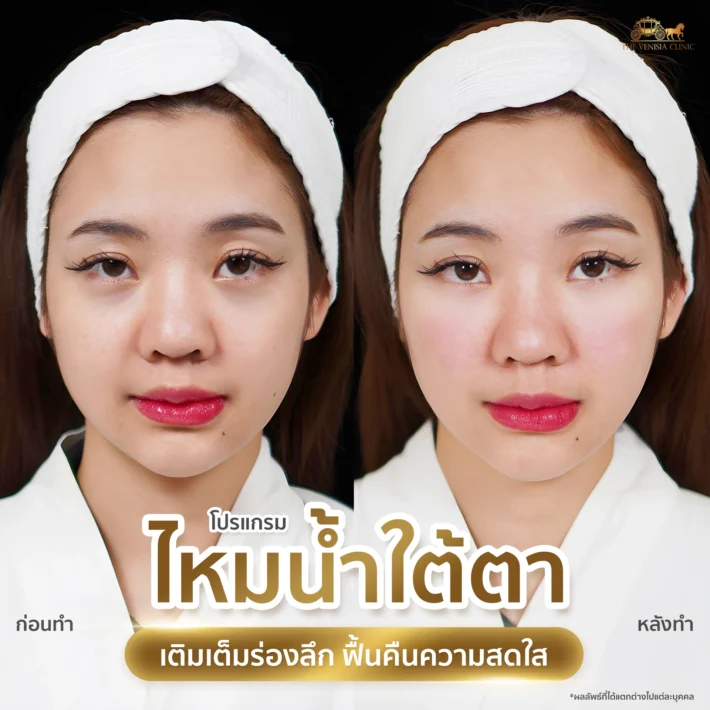 รีวิวผลลัพธ์ไหมน้ำใต้ตา ลดความหมองคล้ำ ใต้ตาดูสดใสขึ้นด้วย Ultra Filler