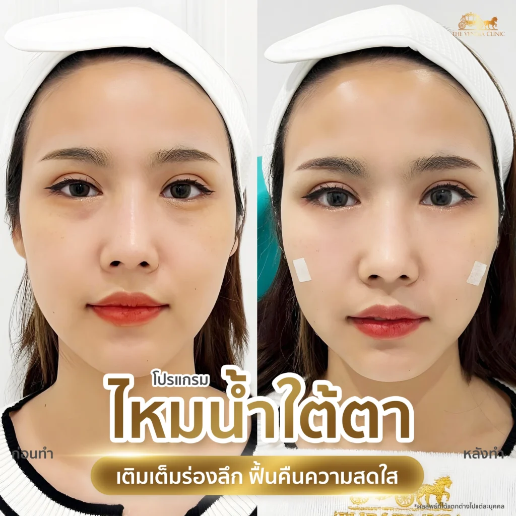 รีวิวไหมน้ำฟื้นฟูใต้ตาแบบไม่ต้องพักฟื้น