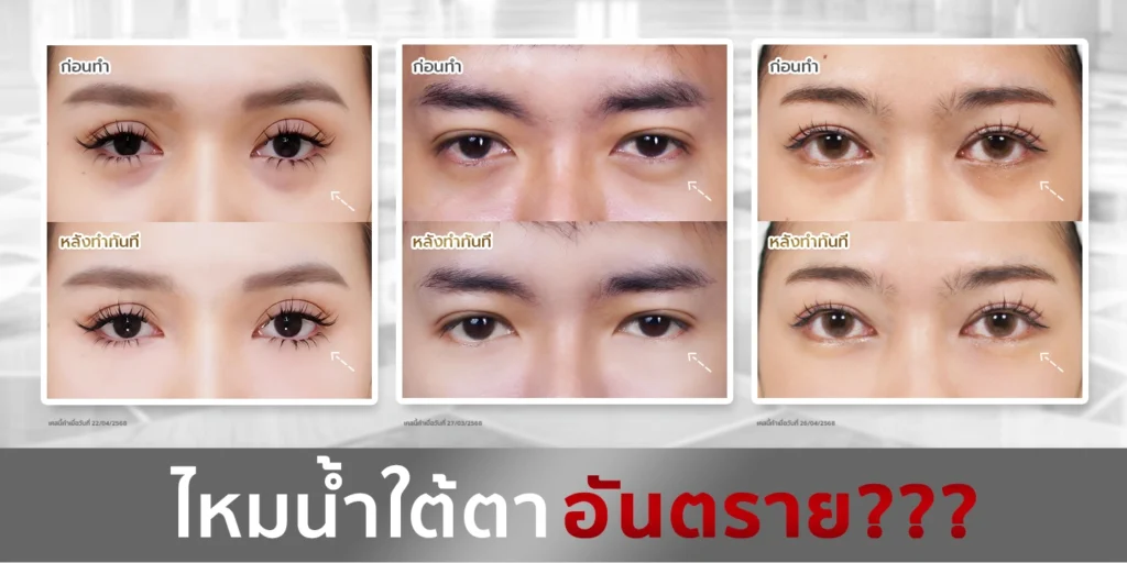 ภาพเปรียบเทียบก่อนและหลังฉีดไหมน้ำ Ultra Filler ใต้ตาในผู้หญิงและผู้ชาย