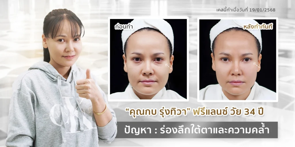 รีวิวไหมน้ำใต้ตา ของคุณกบ วัย 34 ปี ปรับร่องลึกใต้ตาและลดความคล้ำ