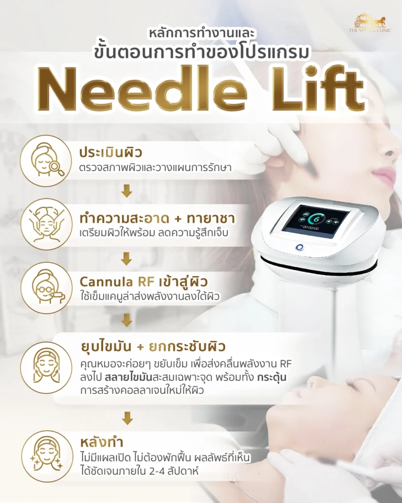 ขั้นตอนทำ Needle Lift เพื่อยกกระชับหน้าและสลายไขมันด้วยพลังงาน RF