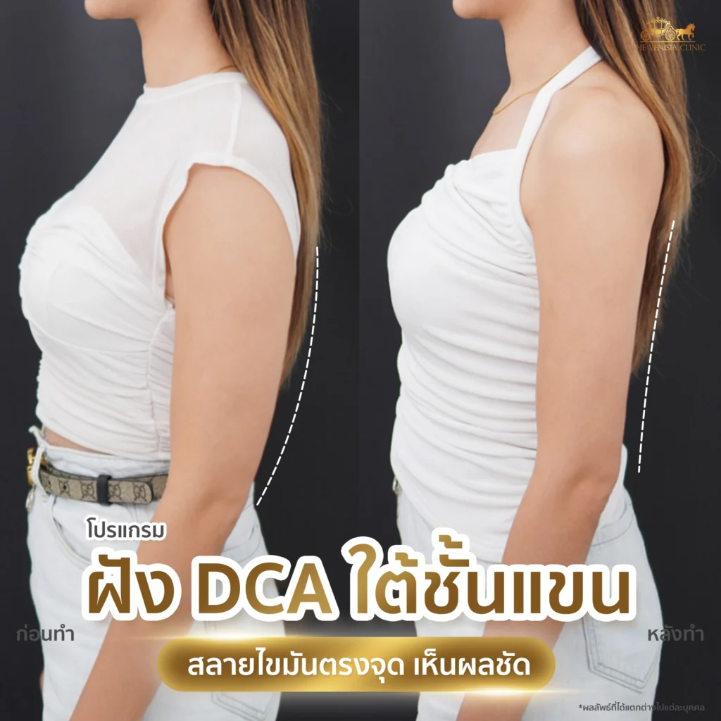 รีวิว DCA ใต้ชั้นแขน ภาพก่อนและหลังทำ ลดไขมันต้นแขน เห็นผลชัด