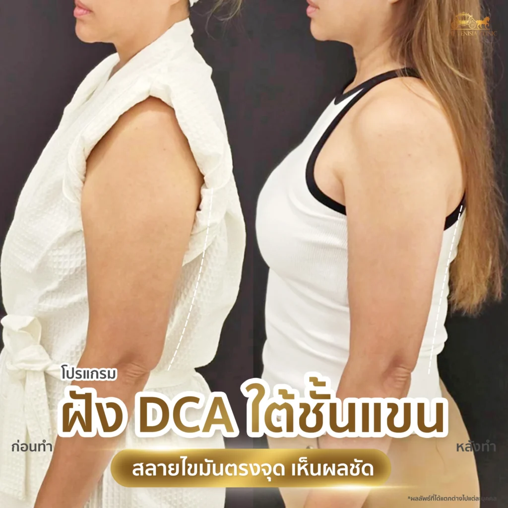 รีวิว DCA ต้นแขน เปรียบเทียบก่อนและหลังทำ เห็นการเปลี่ยนแปล