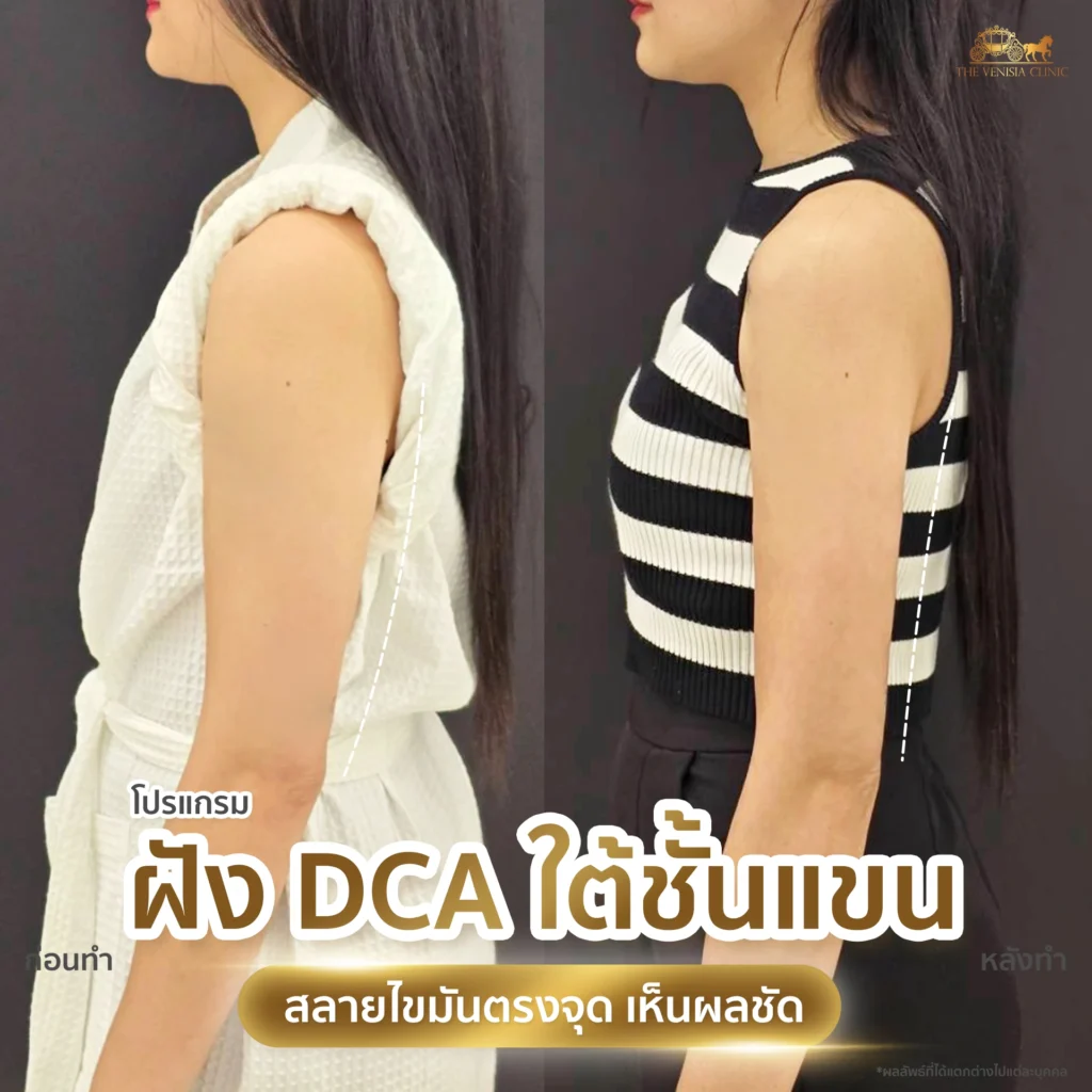 รีวิว DCA ลดไขมันต้นแขน ภาพเปรียบเทียบผลลัพธ์ก่อนและหลัง