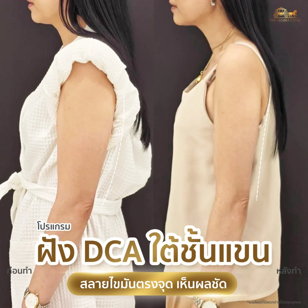 รีวิว DCA ใต้ชั้นแขน ภาพก่อนและหลังทำ เห็นผลการลดไขมันตรงจุด