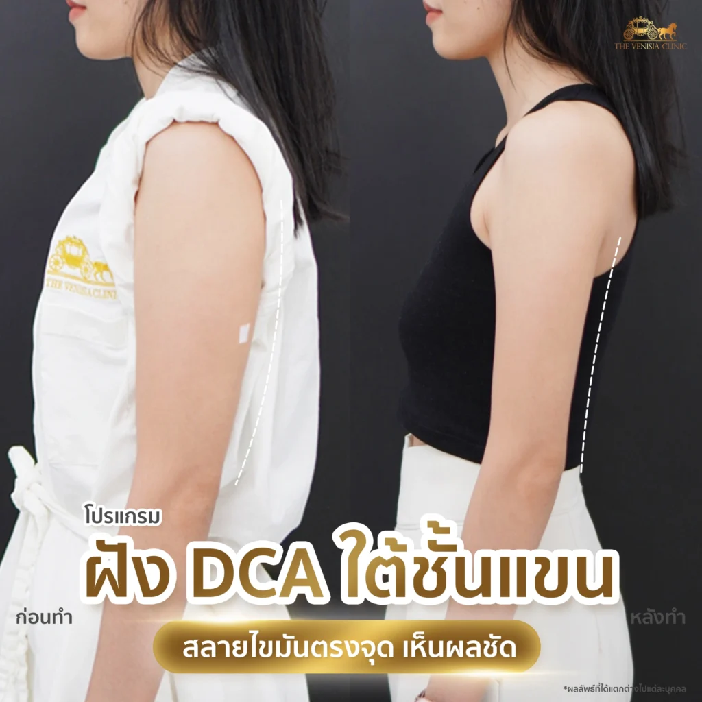 รีวิว DCA ใต้ชั้นแขน ภาพเปรียบเทียบ แขนกระชับหลังทำ
