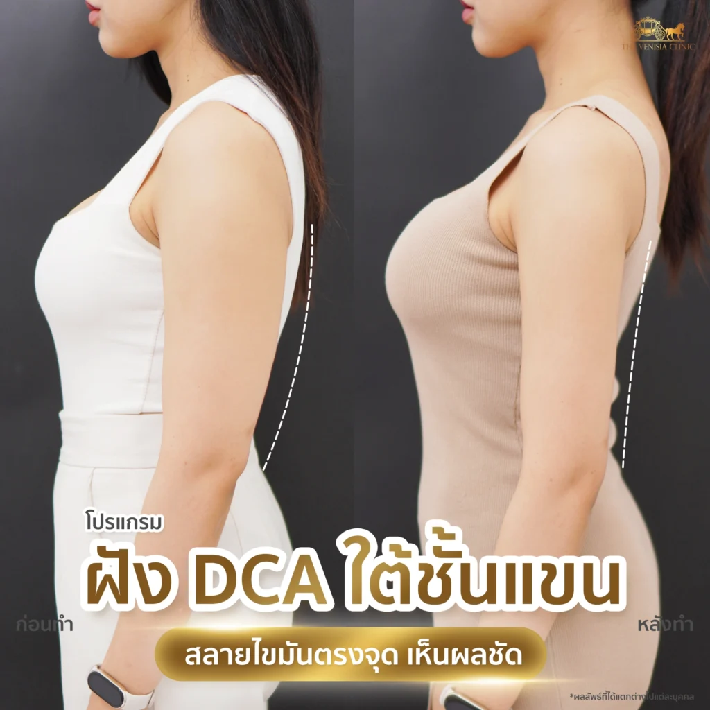 รีวิว DCA ลดไขมันต้นแขน ภาพก่อนและหลัง แขนกระชับ