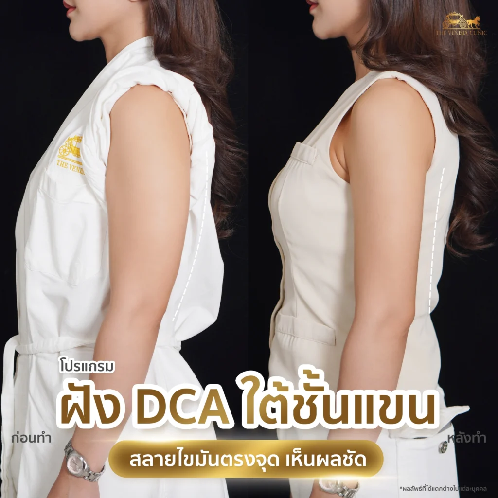 รีวิว DCA ต้นแขน ภาพเปรียบเทียบก่อนและหลังทำ เห็นผลชัด