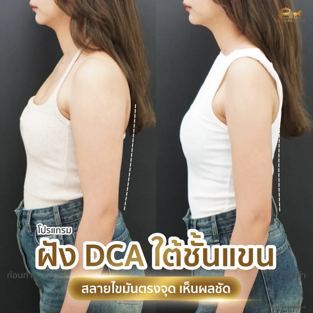 รีวิว DCA ใต้ชั้นแขน ผลลัพธ์หลังทำ แขนกระชับเรียว