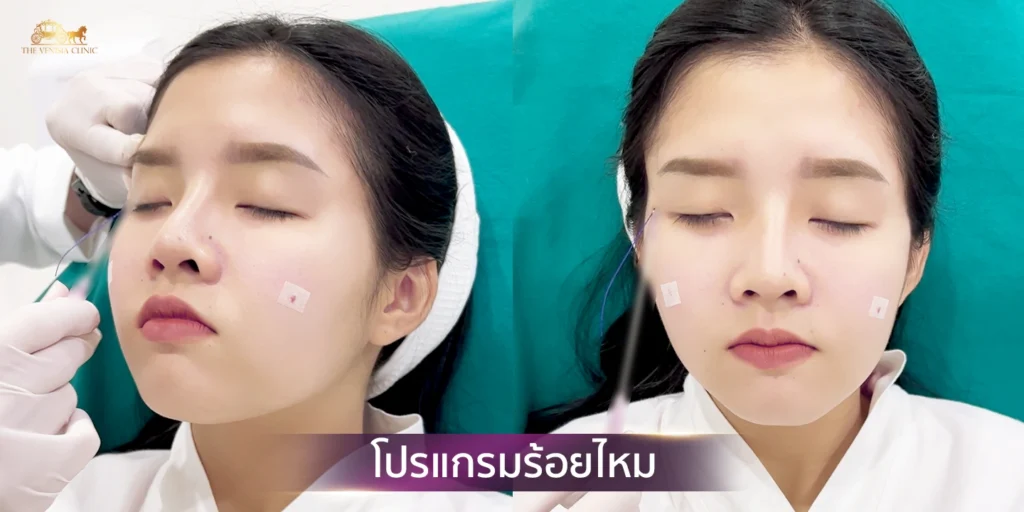 ขั้นตอนการทำร้อยไหม ยกกระชับผิวหน้า
