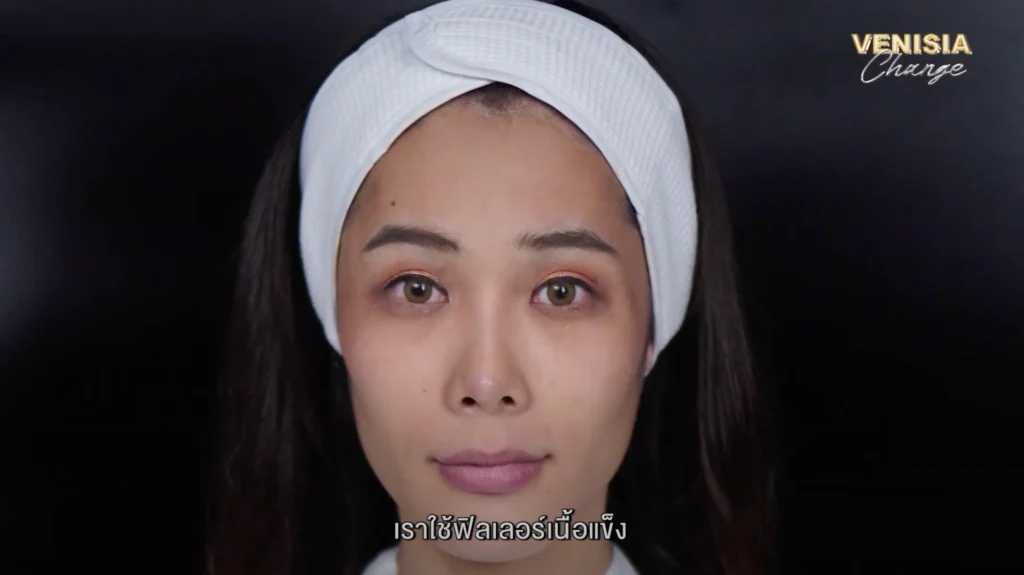 ภาพใบหน้าคุณตูน ก่อนทำฟิลเลอร์ปาก ที่ The Venisia Clinic ซึ่งมีปัญหา ปากบาง และ ปากไม่เท่ากัน