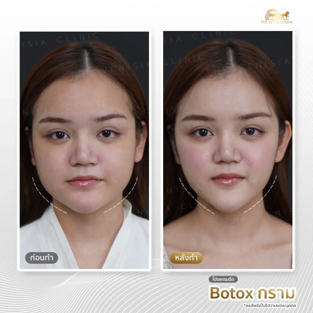 รีวิวฉีดโบท็อก กราม ก่อน-หลัง ทำหน้าเรียว ลดกรามใหญ่ The Venisia Clinic