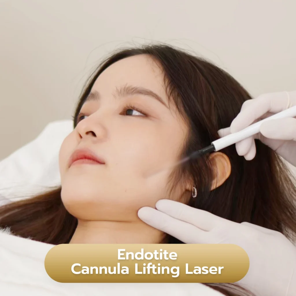 บริการ Endotite Cannula Lifting Laser