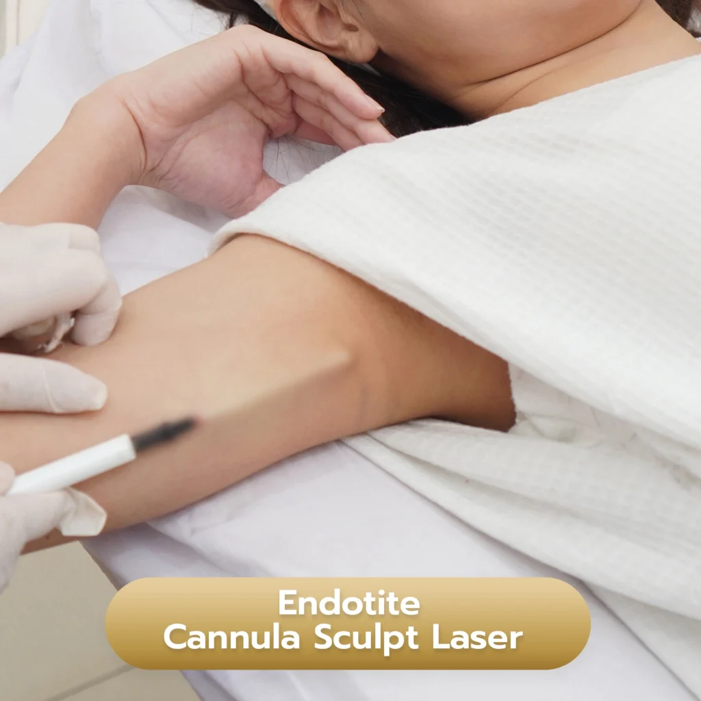 บริการ Endotite Cannula Sculpt Laser