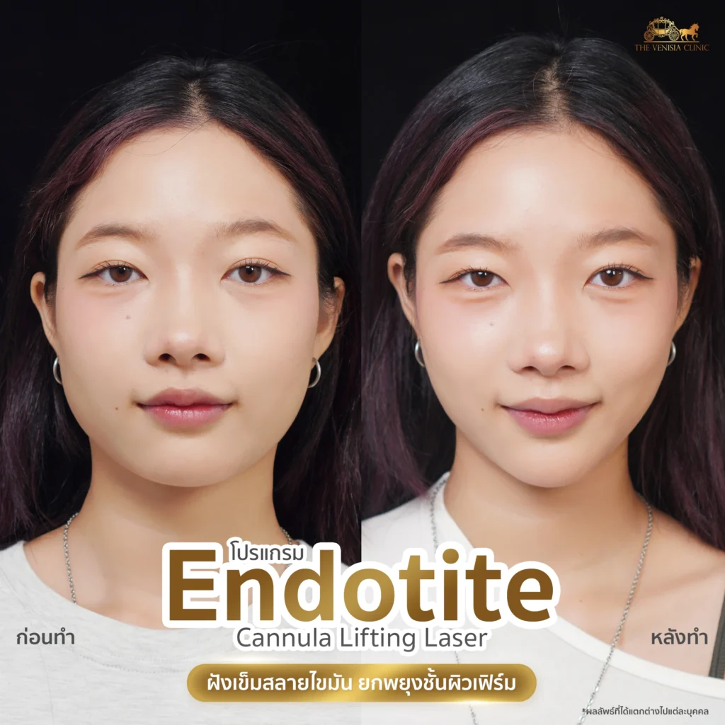 โปรแกรม Endotite หน้าเรียว กรอบหน้าคมชัดขึ้น สลายไขมันแก้ม The Venisia Clinic
