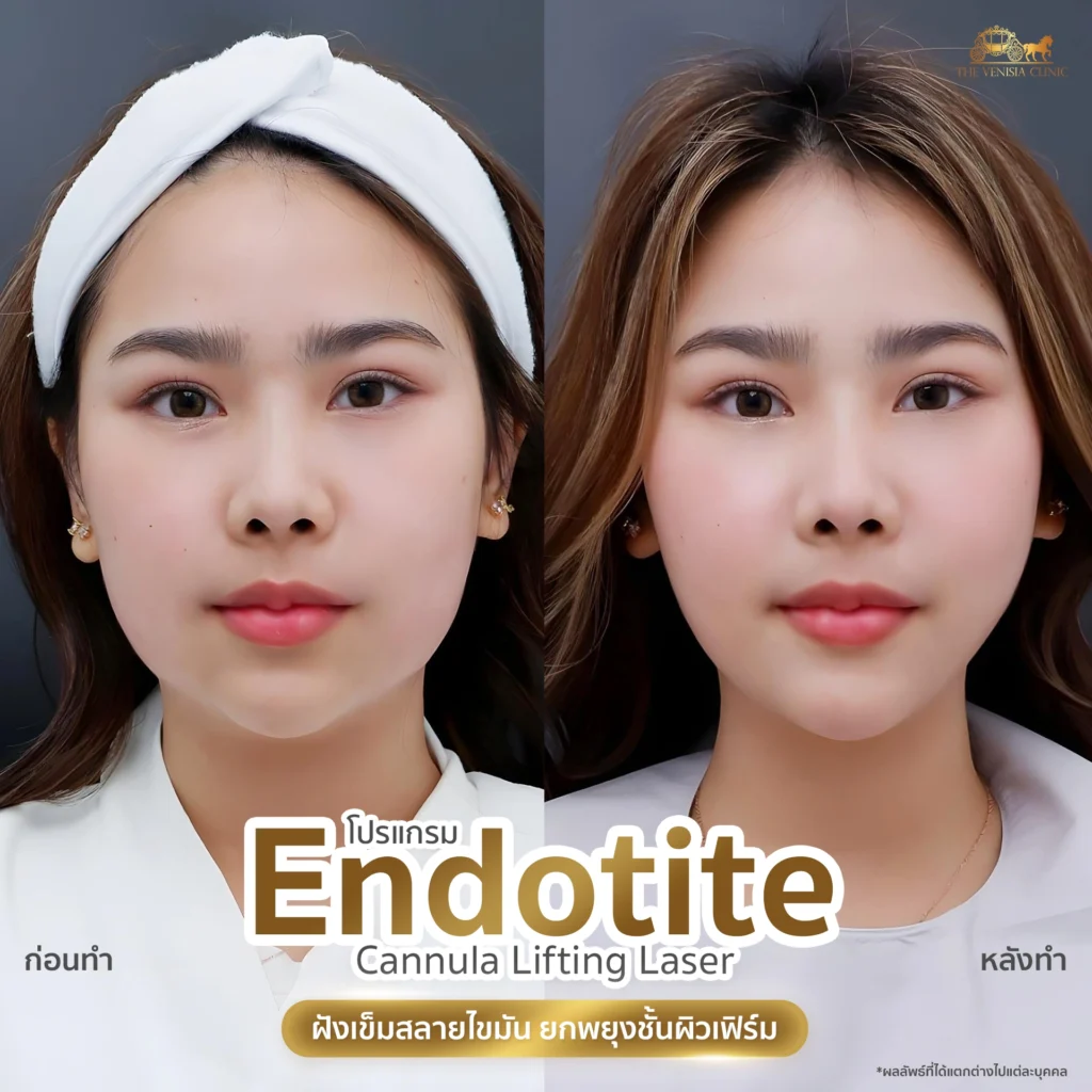 รีวิว Endotite ที่ The Venisia Clinic แก้ปัญหาหน้าบาน ให้หน้าเรียวขึ้น