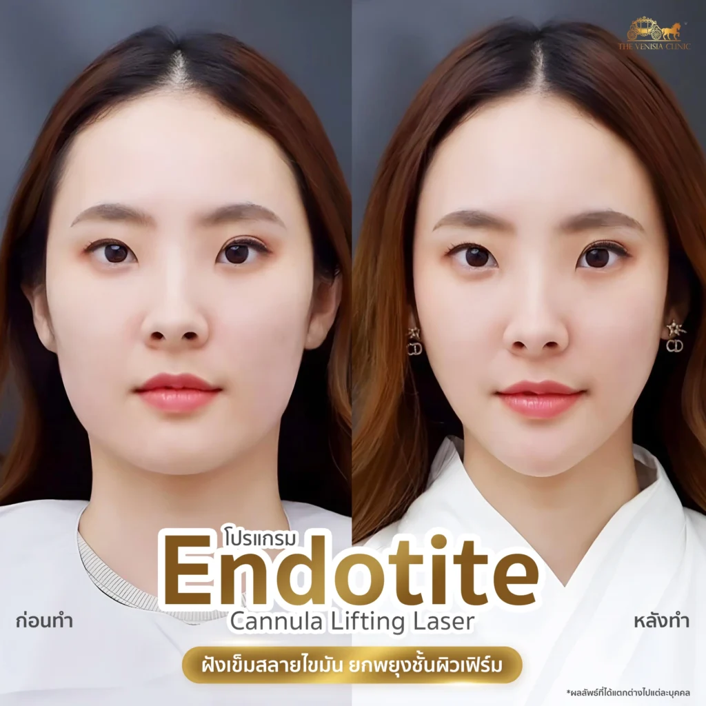 รีวิวโปรแกรม สลายไขมัน ยกแก้ม ลดความหย่อนคล้อย หน้าเรียวทันตา