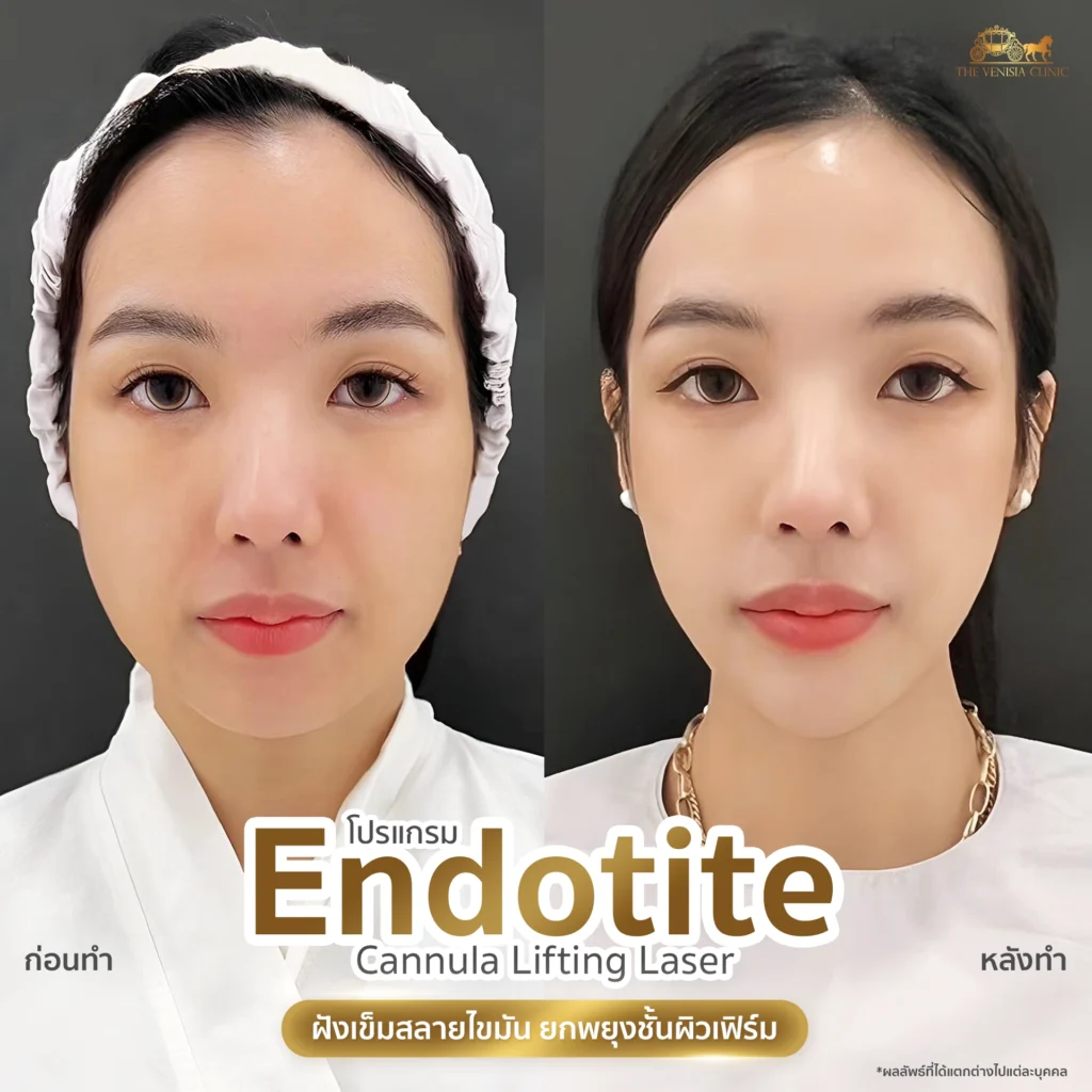 รีวิว Endotite Cannula Lifting Laser แก้ปัญหาหน้าใหญ่ กรอบหน้าไม่ชัด