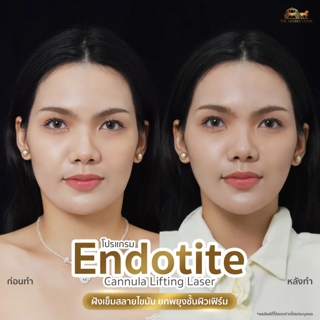 Before-After ยกกระชับหน้า ลดแก้มและเหนียงอย่างเห็นได้ชัด