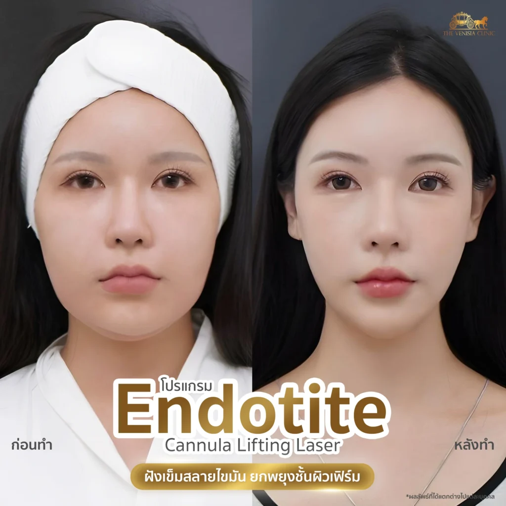 รีวิวโปรแกรม ยกกระชับผิวหน้าบริเวณส่วนกลาง หน้าดูเฟิร์มขึ้น