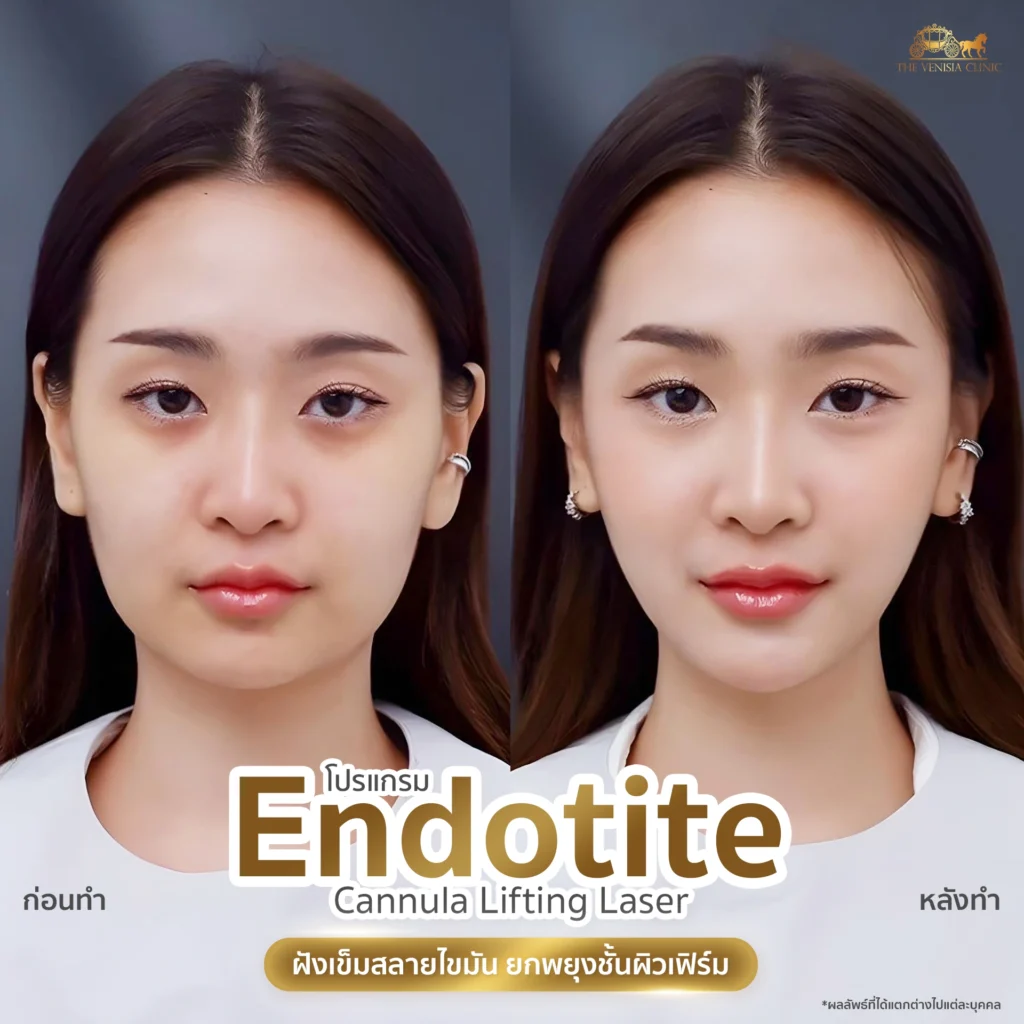 Endotite Cannula Lifting Laser แก้ปัญหาหน้าใหญ่ ให้เรียววีเชฟสวยได้รูป