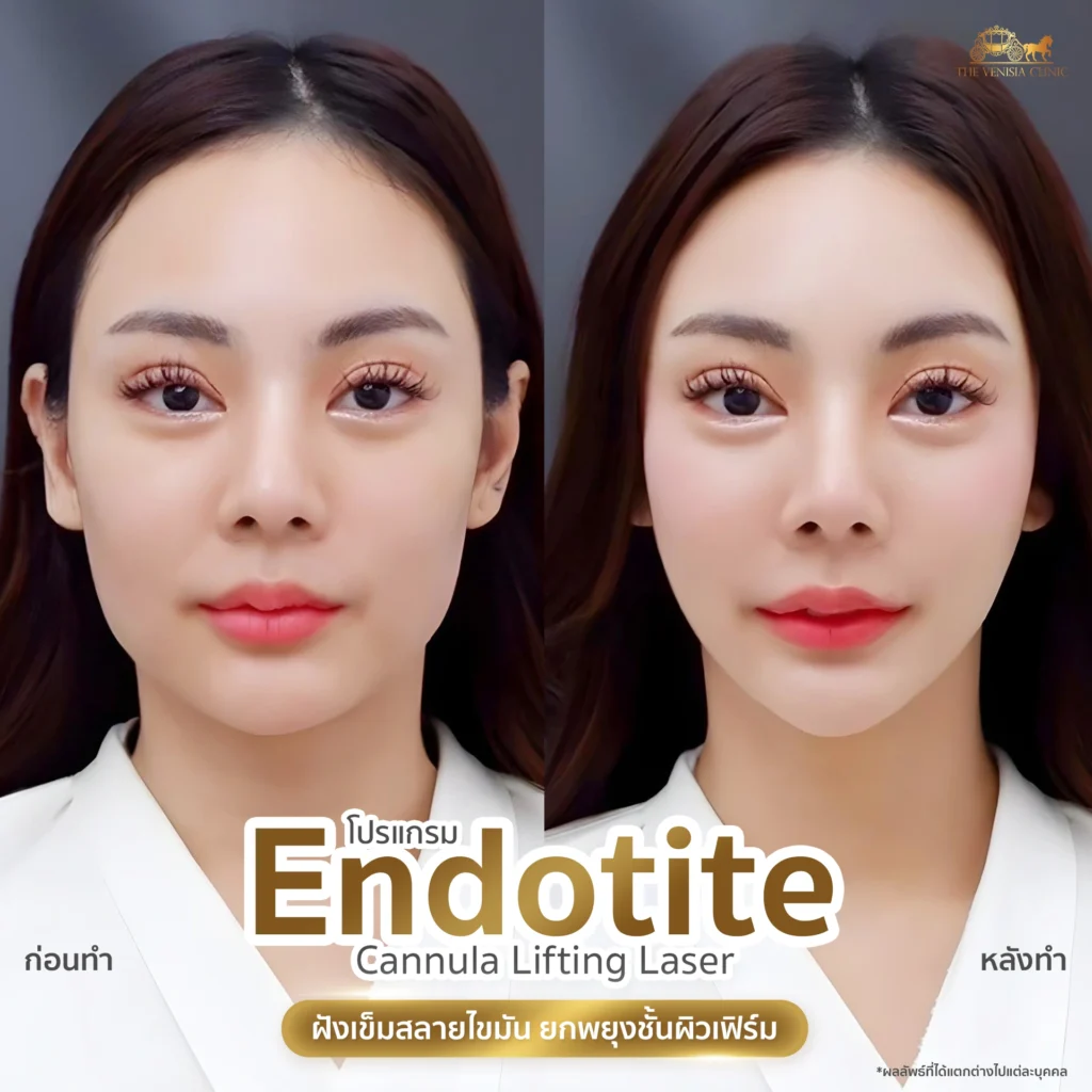 รูป Before After ยกคาง ลดความหย่อนคล้อย