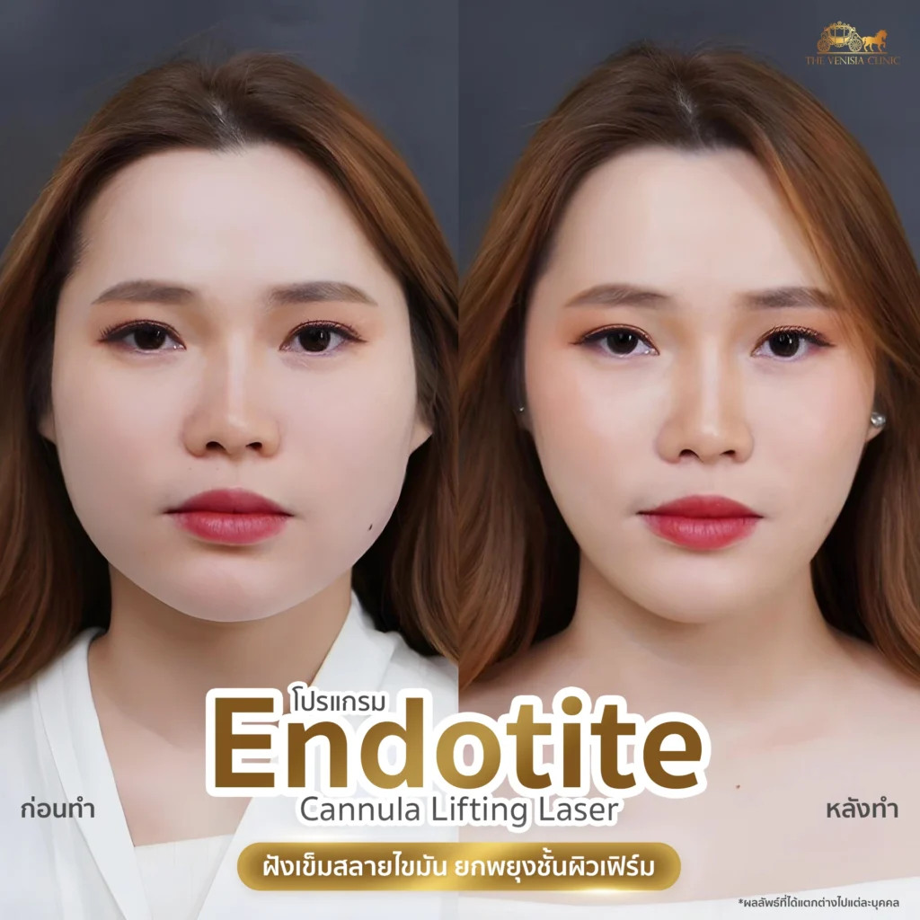 ก่อนและหลังทำ หน้าดูเล็กลง ลดโหนกแก้มสูง