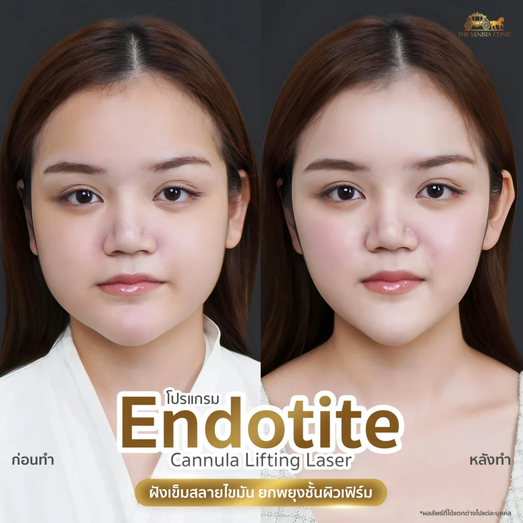 Review สลายไขมันแก้มเยอะ ทำให้หน้าดูอ่อนเยาว์และสมส่วนขึ้น