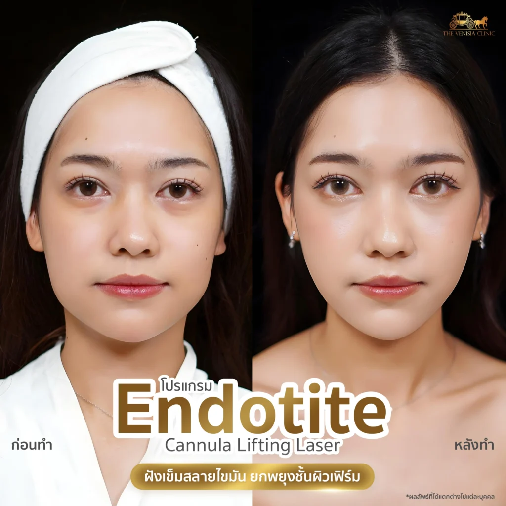 หน้าเรียวทันทีหลังทำ กรอบหน้าดูยกขึ้นอย่างเป็นธรรมชาติ